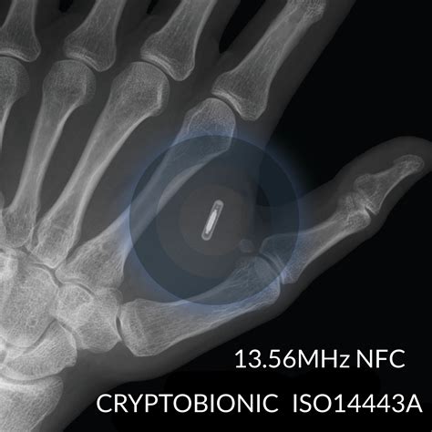 implant nfc tag|new rfid implants.